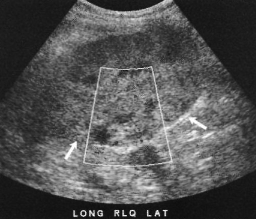УЗИ: Гематома УЗИ: Гематома
