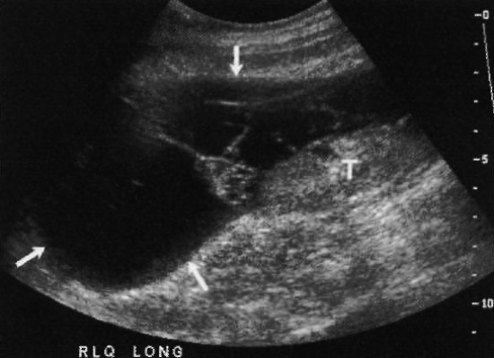 УЗИ: Лимфоцеле УЗИ: Лимфоцеле