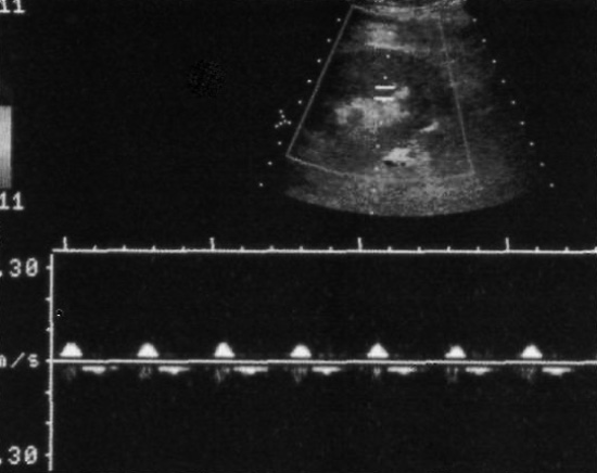 УЗИ: Тромбоз почечной вены УЗИ: Тромбоз почечной вены