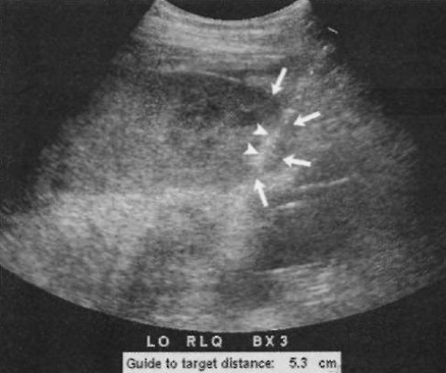 УЗИ: Биопсия трансплантата почки УЗИ: Биопсия трансплантата почки
