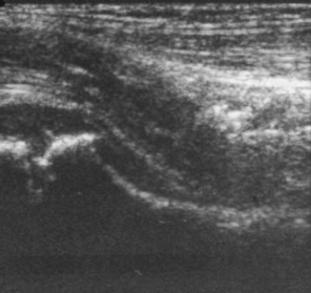 УЗИ: Капсула тазобедренного сустава в норме УЗИ: Капсула тазобедренного сустава в норме