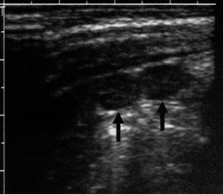 УЗИ: Увеличенные мезентериальные лимфоузлы УЗИ: Увеличенные мезентериальные лимфоузлы