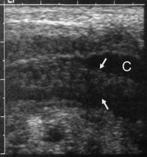 УЗИ: Аппендицит УЗИ: Аппендицит