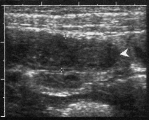 УЗИ: Аппендицит УЗИ: Аппендицит