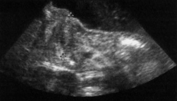 УЗИ: Гипертрофический стеноз привратника УЗИ: Гипертрофический стеноз привратника