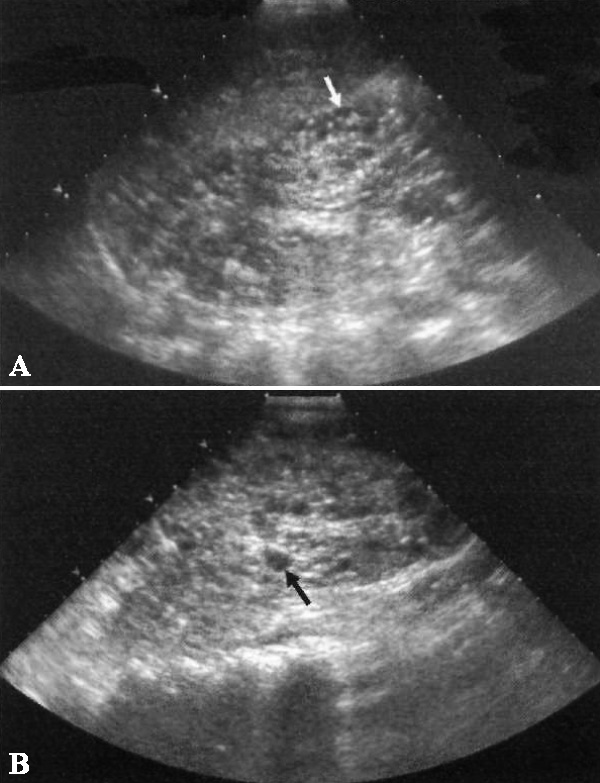 УЗИ: Аутосомно-рецессивный поликистоз почек УЗИ: Аутосомно-рецессивный поликистоз почек