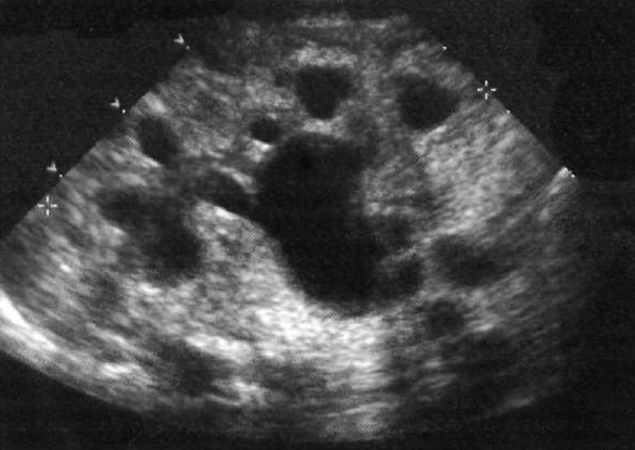 УЗИ: Почка новорожденного УЗИ: Почка новорожденного