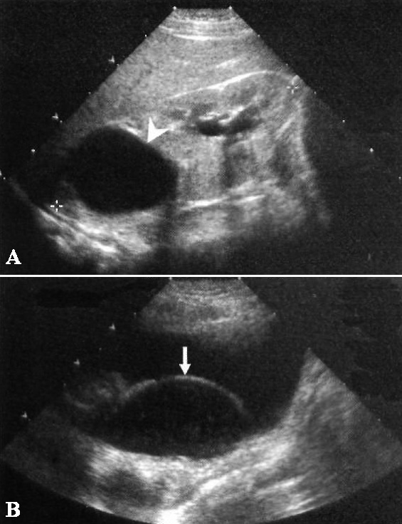 УЗИ: Гидронефроз и уретероцеле УЗИ: Гидронефроз и уретероцеле