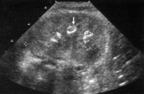 УЗИ: Почка недоношенного ребенка УЗИ: Почка недоношенного ребенка