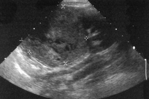УЗИ: Нефробластома УЗИ: Нефробластома