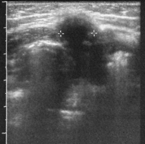 УЗИ: Пазуха урахуса УЗИ: Пазуха урахуса