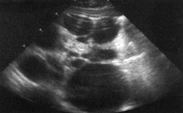 УЗИ: Мультикистоз почки УЗИ: Мультикистоз почки