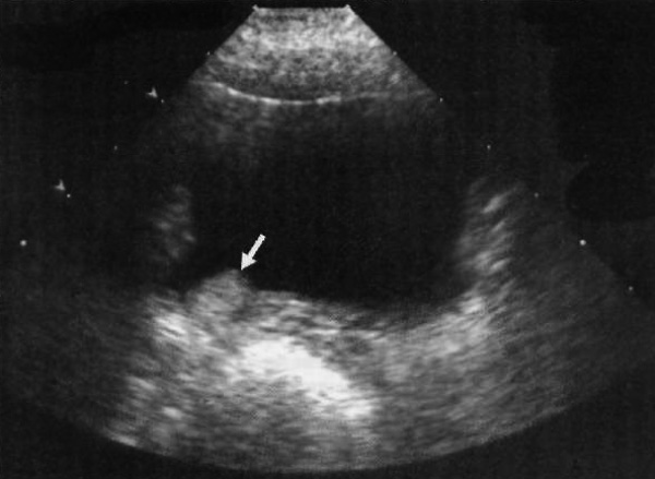 УЗИ: Мочевой пузырь УЗИ: Мочевой пузырь