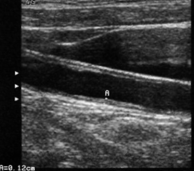 УЗИ: Утолщение стенки артерии УЗИ: Утолщение стенки артерии