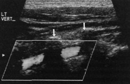 УЗИ: Позвоночная артерия в норме УЗИ: Позвоночная артерия в норме