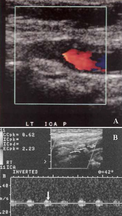 УЗИ: Окклюзия внутренней сонной артерии УЗИ: Окклюзия внутренней сонной артерии