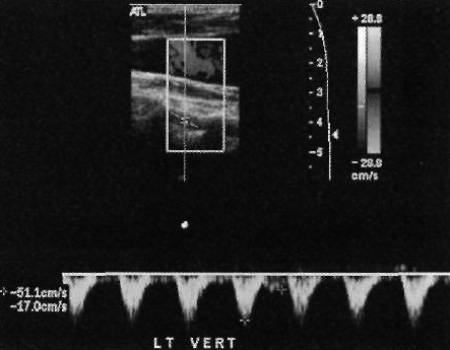 УЗИ: Подключичное «обкрадывание» УЗИ: Подключичное «обкрадывание»