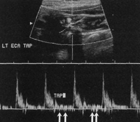 УЗИ: Височное постукивание УЗИ: Височное постукивание
