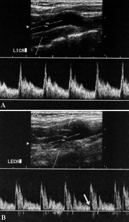 УЗИ: Допплерограмма нормальных сонных артерий УЗИ: Допплерограмма нормальных сонных артерий