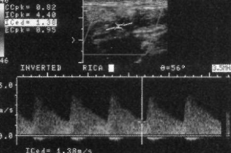 УЗИ: Тяжелый стеноз внутренней сонной артерии УЗИ: Тяжелый стеноз внутренней сонной артерии