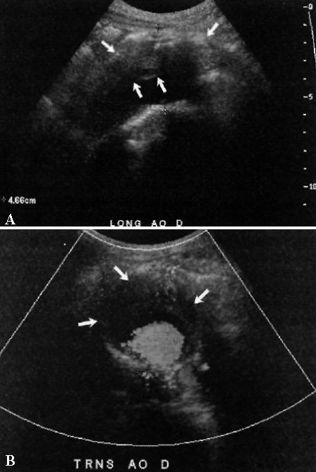 УЗИ: Аневризма брюшного отдела аорты УЗИ: Аневризма брюшного отдела аорты