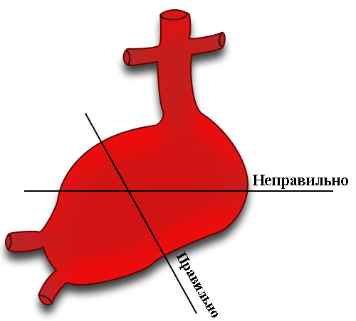 Методика измерения аневризмы Методика измерения аневризмы
