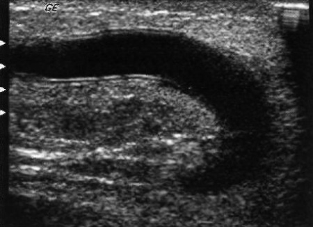 УЗИ: Шунт в норме УЗИ: Шунт в норме