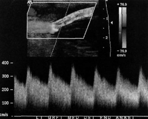 Допплерография: Стеноз шунта Допплерография: Стеноз шунта