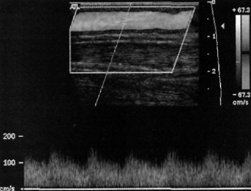 Спектральная допплерография шунта в норме Спектральная допплерография шунта в норме