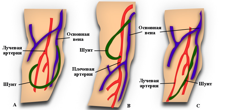 Варианты установки шунта для гемодиализа Варианты установки шунта для гемодиализа