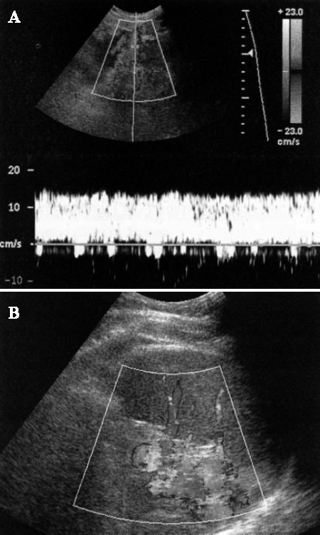 Допплерография: Коллатерали Допплерография: Коллатерали