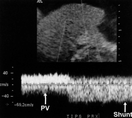 Допплерография TIPS Допплерография TIPS