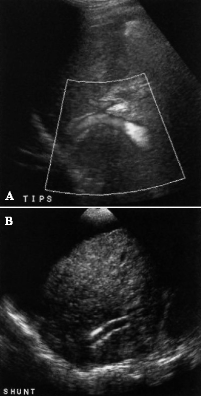 Допплерография TIPS Допплерография TIPS