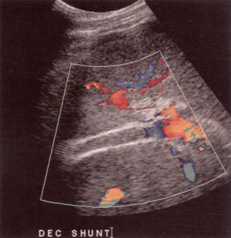 Допплерография обтурированного TIPS Допплерография обтурированного TIPS