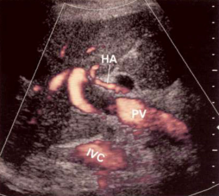 Допплерография: Сгусток крови в воротной вене Допплерография: Сгусток крови в воротной вене