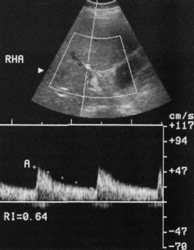 Допплерография печеночной артерии Допплерография печеночной артерии