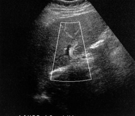 Артериализация Артериализация