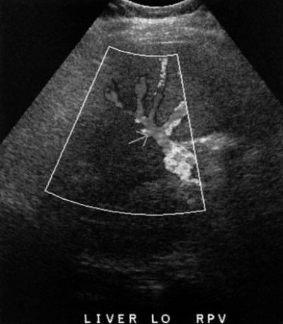 Допплерография: Портальный кровоток при TIPS Допплерография: Портальный кровоток при TIPS