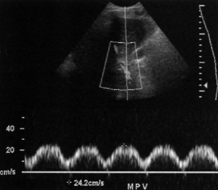 Допплерография: Пульсирующий венозный кровоток в воротной вене Допплерография: Пульсирующий венозный кровоток в воротной вене