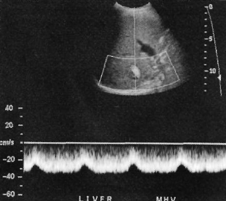 Допплерография: Печеночные вены Допплерография: Печеночные вены