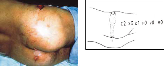 Ранение левой ягодицы Ранение левой ягодицы