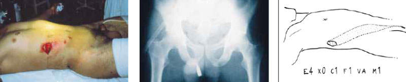 Пулевое ранение брюшной полости Пулевое ранение брюшной полости