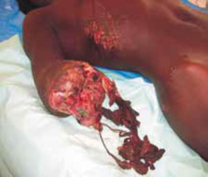 Травматическая ампутация предплечья Травматическая ампутация предплечья