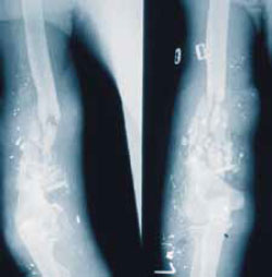 Тяжелый раздробленный перелом плечевой кости Тяжелый раздробленный перелом плечевой кости