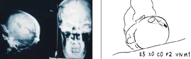 Осколочное ранение головы Осколочное ранение головы