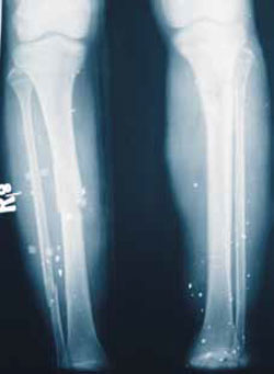 Множественные осколки снаряда Множественные осколки снаряда