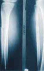 Огнестрельное ранение Огнестрельное ранение