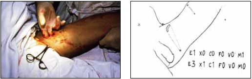 Два осколочных ранения бедра Два осколочных ранения бедра