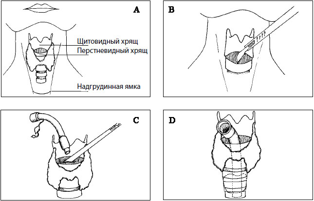 Крикотироидотомия Крикотироидотомия