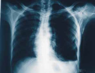 Напряженный пневмоторакс Напряженный пневмоторакс